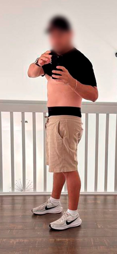 Male Patient — After